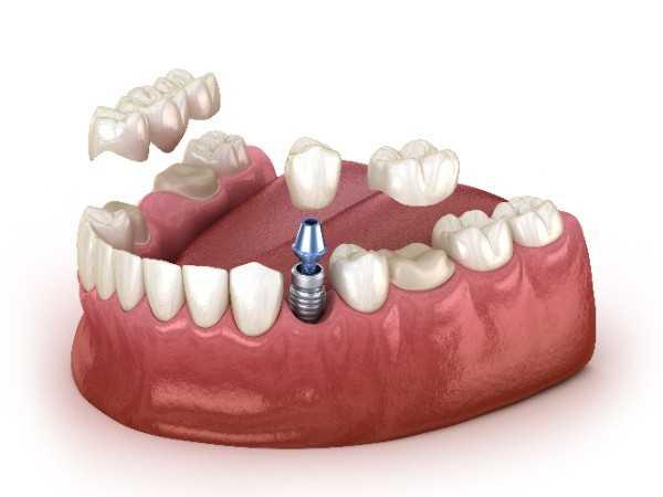 dental implants Belfas