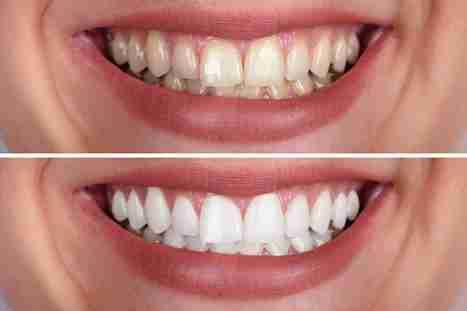 Image source- teeth whitening Dover