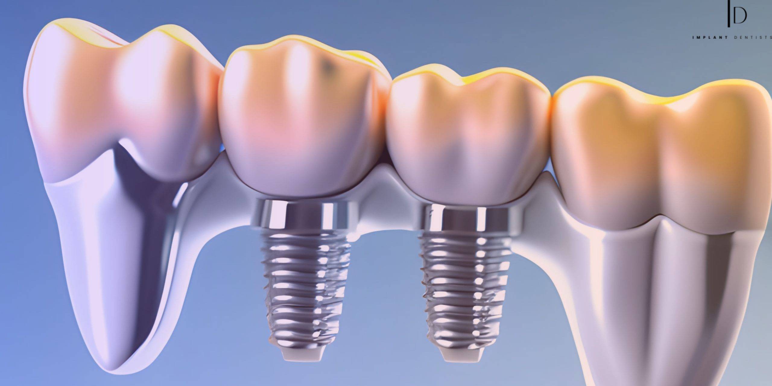 What Are the Main Reasons for Considering Dental Implants? | TheAmberPost
