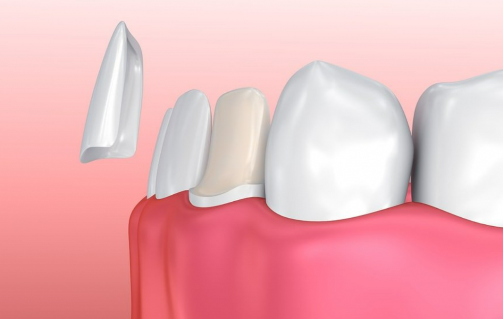 What Problems Can Dental Veneers Fix | TheAmberPost