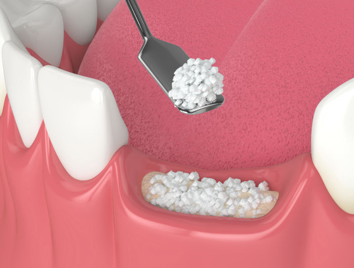 Enhance Your Smile with Top Bone Grafting at Palm Desert Implant Dentist