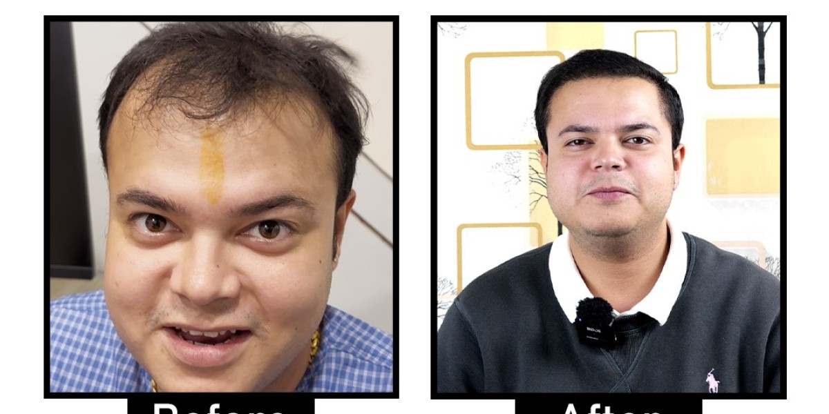 Best Hair Doctor in South Delhi: Expert Solutions for Hair Loss