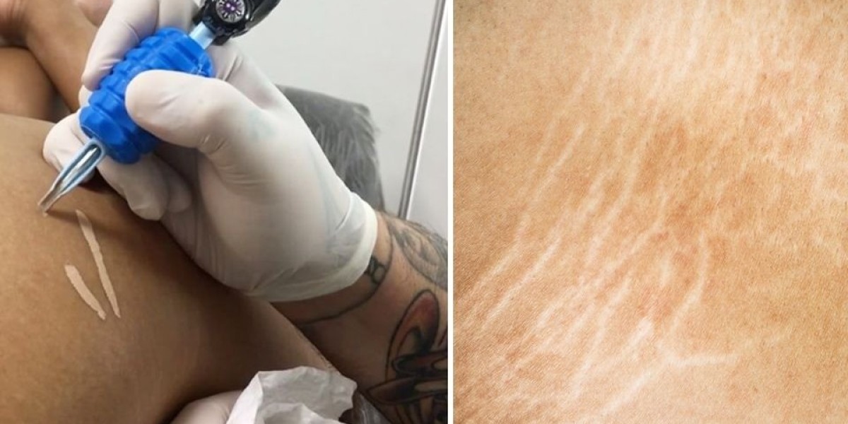 Tattooing Over Stretch Marks: A Creative Solution for Body Confidence